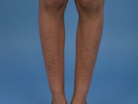 X-gebonden recessieve ichthyosis vulgaris