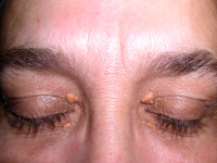Xanthelasma palpebrarum