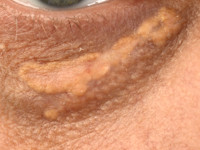 Xanthelasma palpebrarum