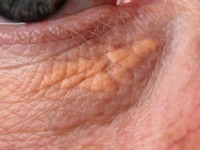 Xanthelasma palpebrarum