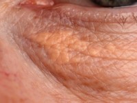 Xanthelasma palpebrarum