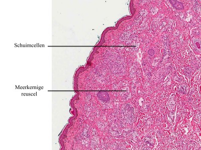 Histologie xanthelasmata