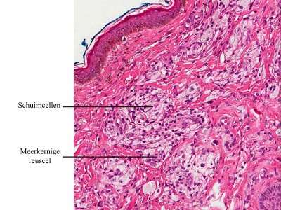 Histologie xanthelasmata