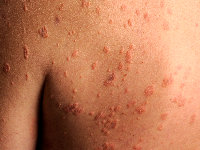 Xanthoma disseminatum