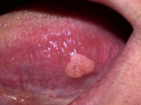 Verruciform xanthoom