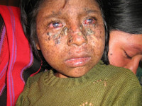 Xeroderma pigmentosum