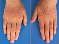 Xeroderma pigmentosum