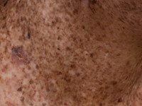 Xeroderma pigmentosum