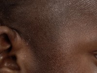 Droge huid bij atopie