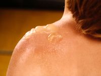 Zonnebrand, sunburn, dermatitis solaris