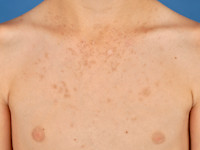 Zonnebrand, sunburn, dermatitis solaris