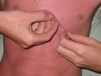 Zonnebrand, sunburn, dermatitis solaris