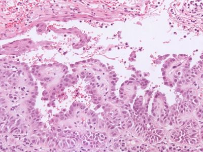 Histologie lineaire Darier
