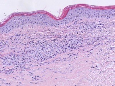 Histologie IgA vasculitis