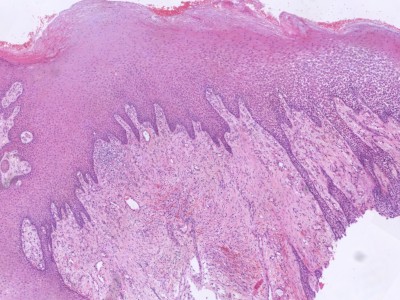 Histologie Kaposi sarcoom