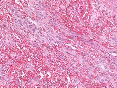 Histologie Kaposi sarcoom