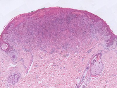 Histologie Spitz naevus