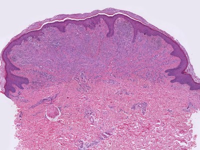 Histologie Spitz naevus