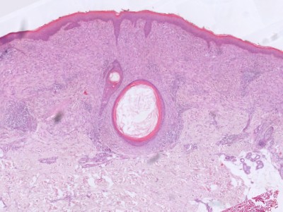 Histologie Spitz naevus