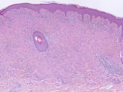 Histologie Spitz naevus