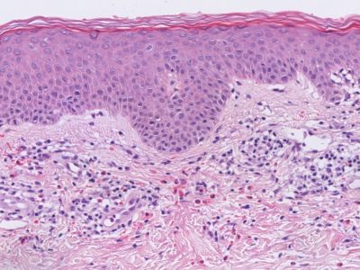 Histologie eosinofiele cellulitis (Wells syndroom)