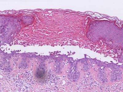 Histologie acantholytische dyskeratose