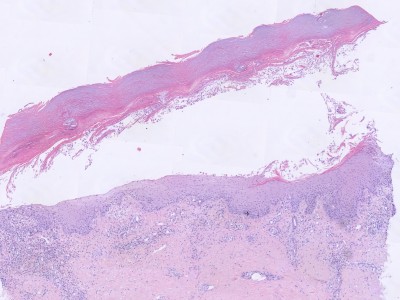 Histologie pompholyx