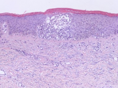 Histologie dyshidrotisch eczeem