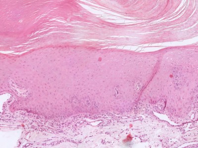 Histologie actinische keratose