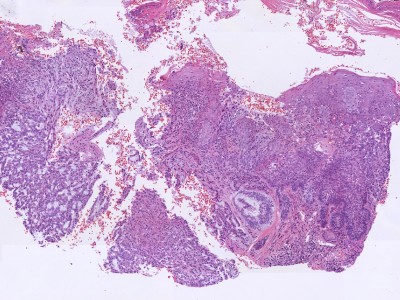 Histologie adenoïd basosquameus carcinoom