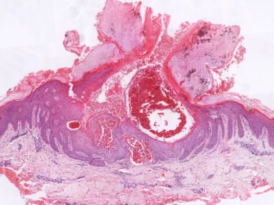 Histologie angiokeratoma