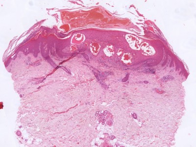 Histologie angiokeratoma