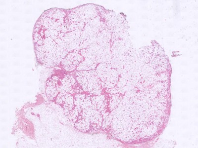 Histologie angiolipoma