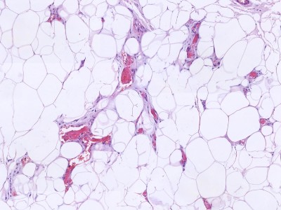 Histologie angiolipoma