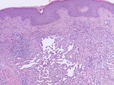 Histologie epithelioid angiosarcoma