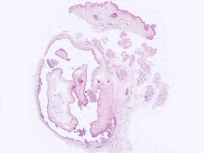 Histologie apocrien hidrocystoma