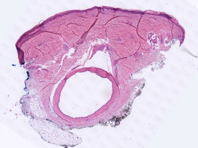 Histologie apocrien hidrocystoma