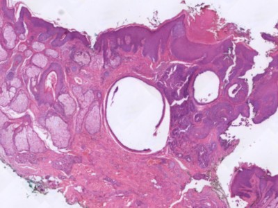 Histologie apocrien hidrocystoma
