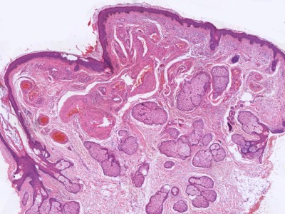 Histologie arterioveneus hemangioom