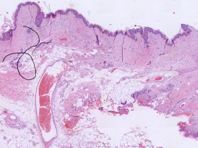 Histologie arterioveneuze malformatie of hemangioom