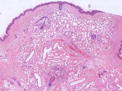 Histologie arterioveneuze malformatie of hemangioom