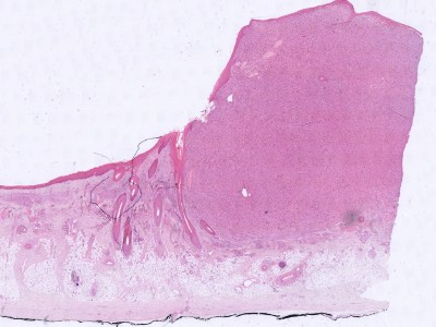 Histologie atypisch fibroxanthoom