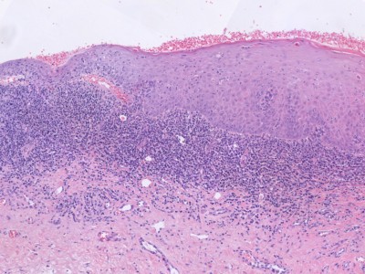 Histologie balanitis plasmocellularis