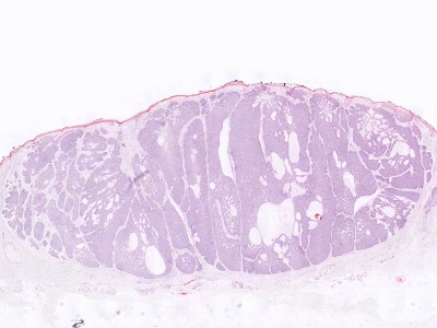 Histologie nodulair basaalcelcarcinoom