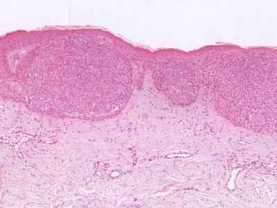 Histologie superficieel multifocaal basaalcelcarcinoom