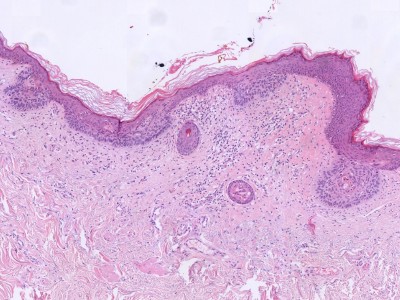 Histologie superficieel multifocaal basaalcelcarcinoom