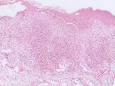 Histologie superficieel basaalcelcarcinoom