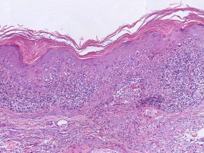 Benigne lichenoide keratosis