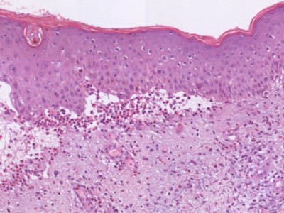 Histologie lichen planus