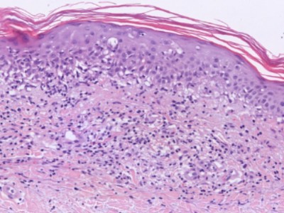 Histologie capillaritis